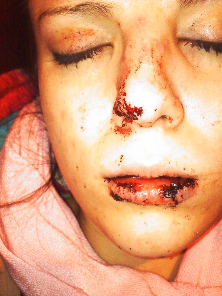 Original personal archive photograph from age 18 showing the aftermath of physical abuse