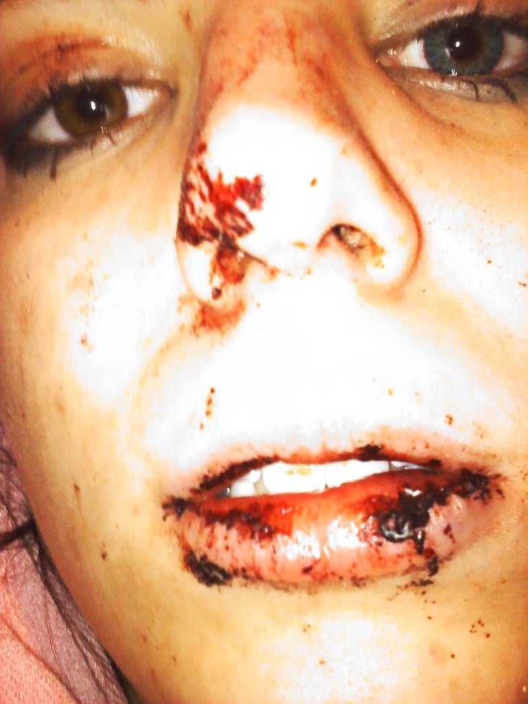 Original personal archive photograph from age 18 showing the aftermath of physical abuse