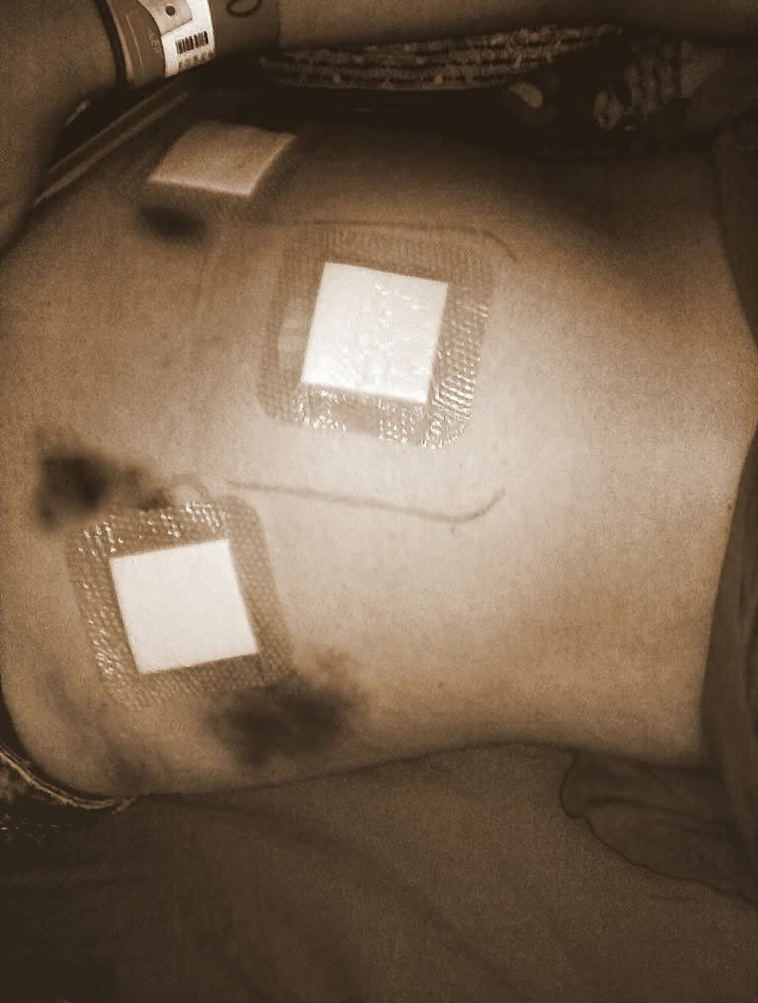 Personal archive photograph showing bruising and medical dressings